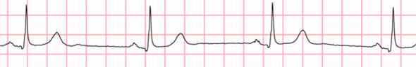 SinusBradycardia_ECGPedia.png